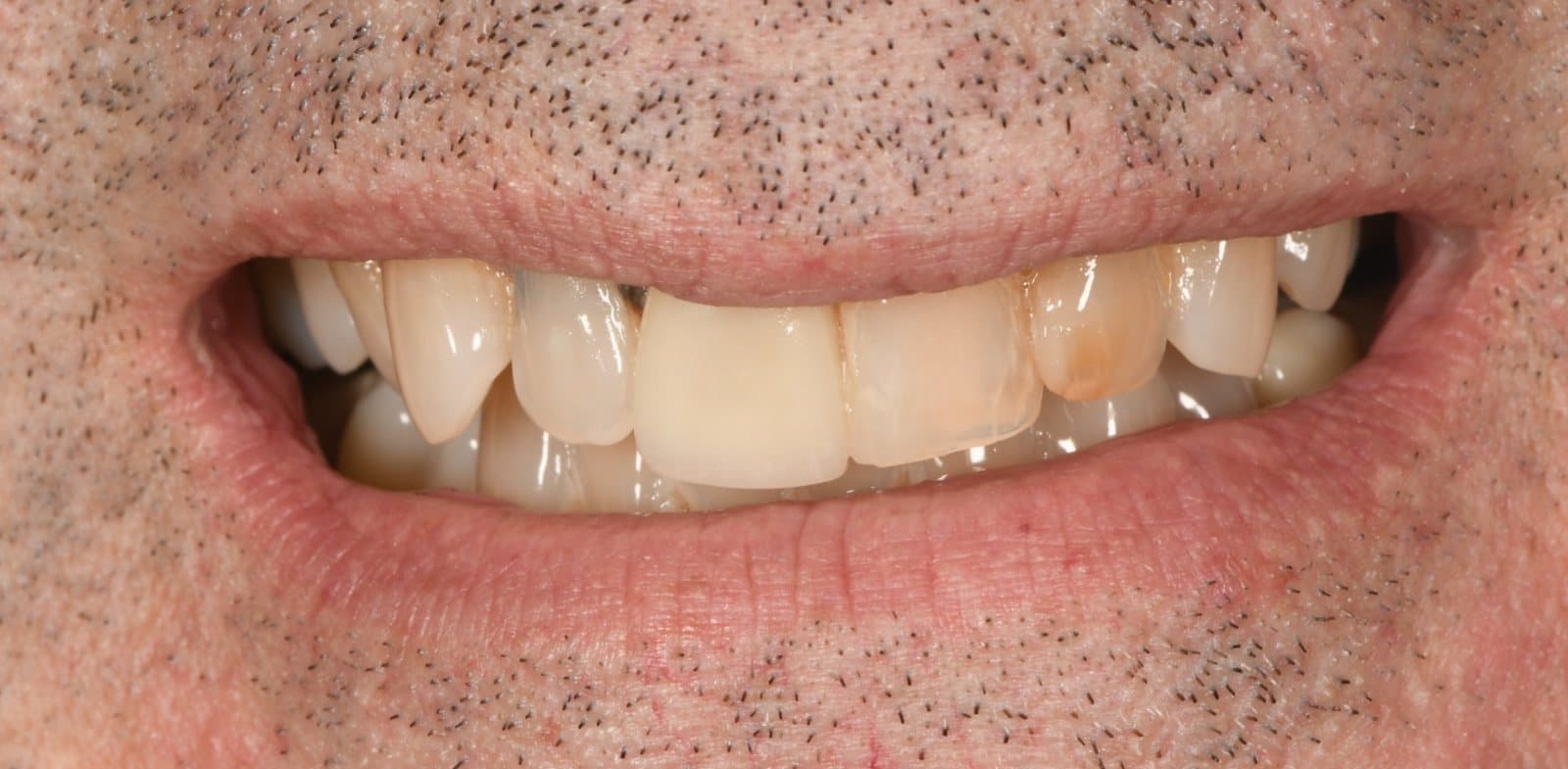 Sourire avant le traitement par facettes de porcelaine, cas 02
