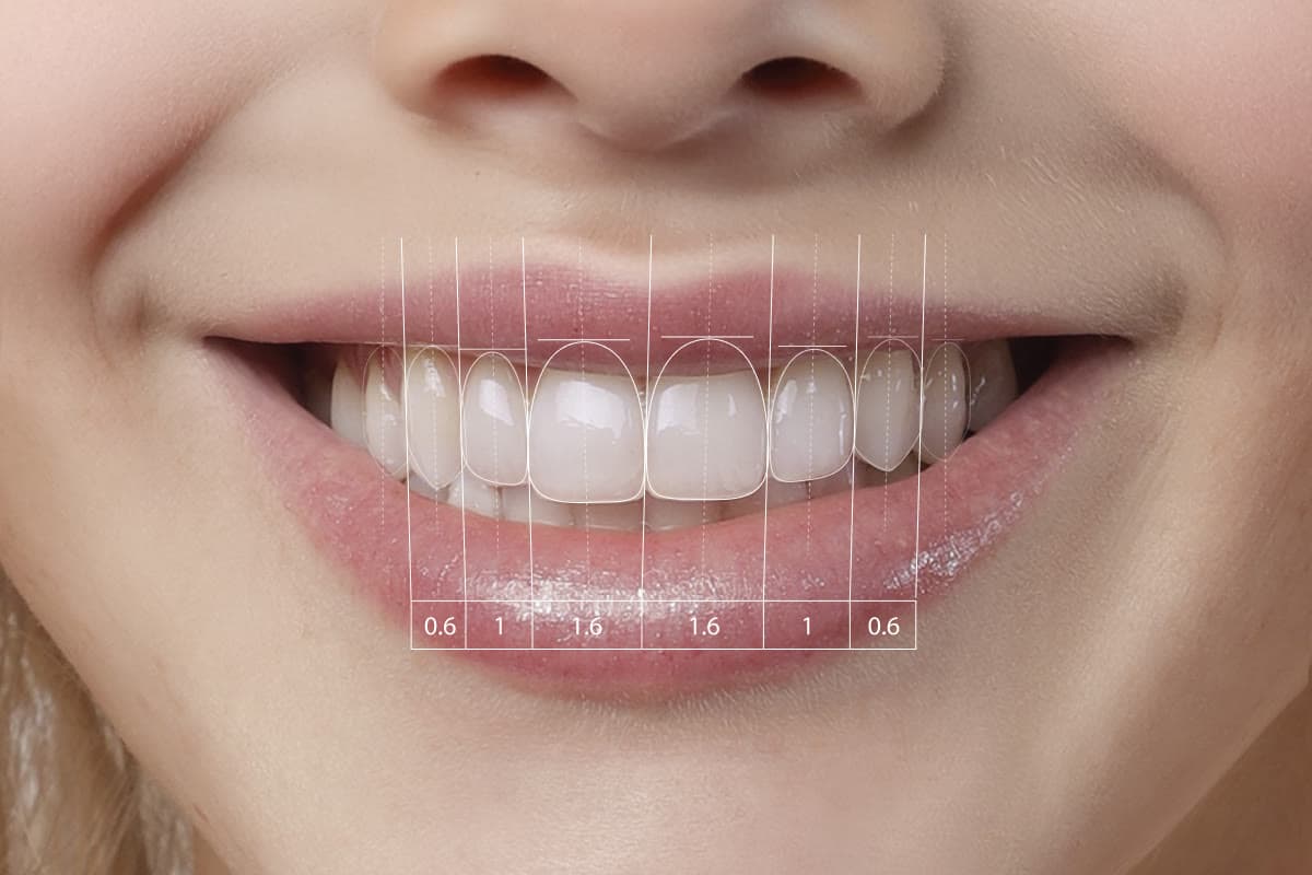 Design du sourire : proportions dentaires tracées sur un sourire